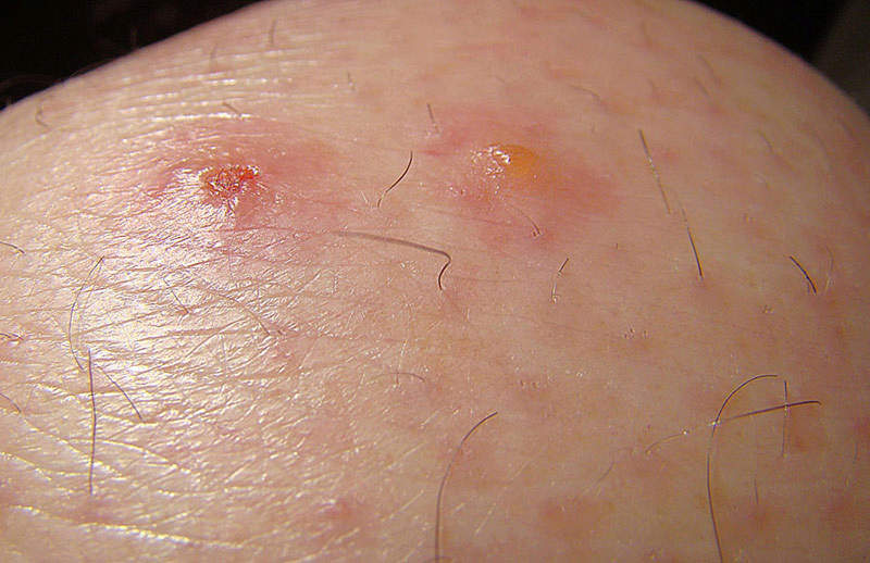 Chigger Mite bite