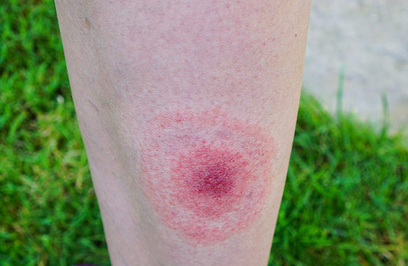 lyme rash on leg